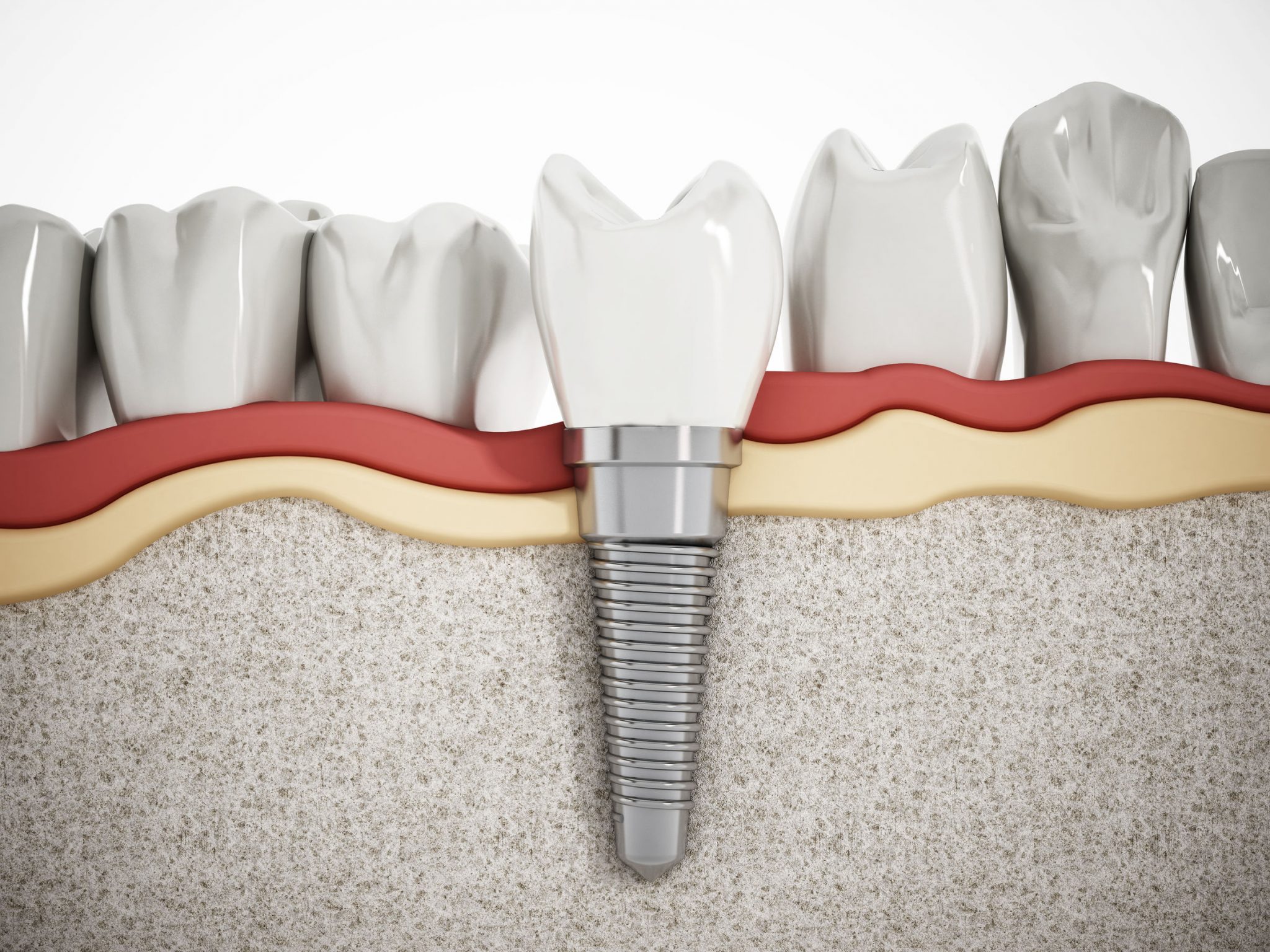 Dental Implants Endodontic & Implant Center